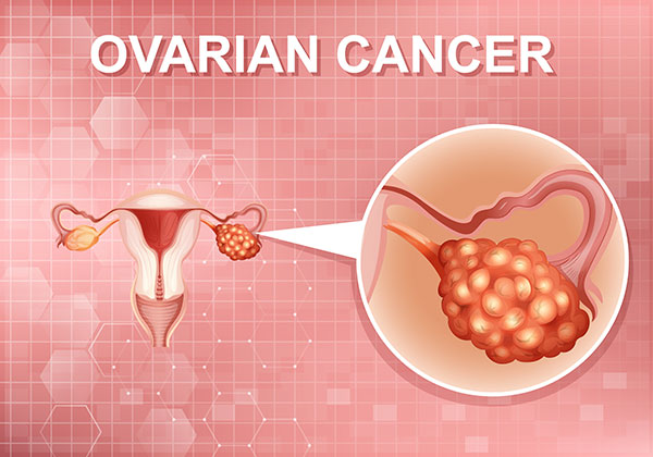 Ovarian-Cancer